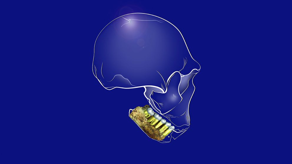 illustration of tooth disease in early humans